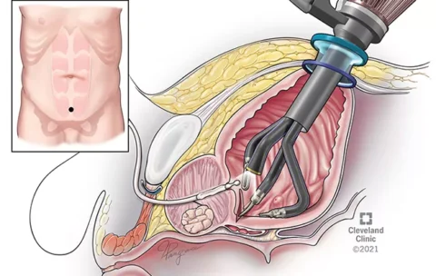 3-Hole Retroperitoneal Radical Prostatectomy