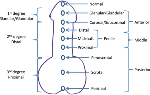 Diagram-of-commonly-used-classifications-of-hypospadias-based-on-location-of-urethral