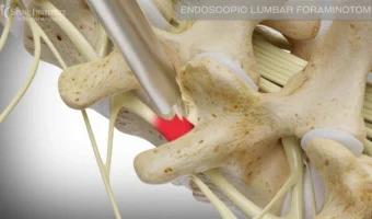 Endoscopic Foraminoplasty