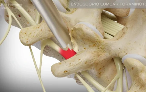 Endoscopic Foraminoplasty