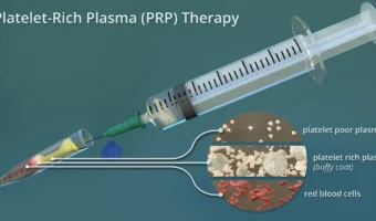 PRP (Platelet-Rich Plasma)