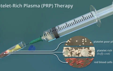 PRP (Platelet-Rich Plasma)