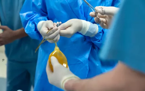 Penile Augmentation-All Procedures