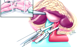 Retroperitoneal-laparoscopic-partial-nephrectomy-Because-of-limited-operative-space-2