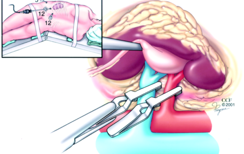 Retroperitoneal-laparoscopic-partial-nephrectomy-Because-of-limited-operative-space-2