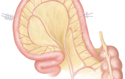 Robotic Bladder Tumor and Neo Bladder Course