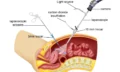 laparoscopic-surgery