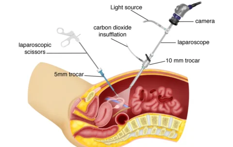 laparoscopic-surgery