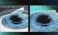 Excimer Laser Refractive Surgery Course