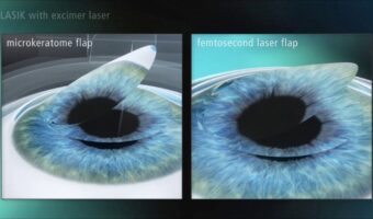 Excimer Laser Refractive Surgery Course