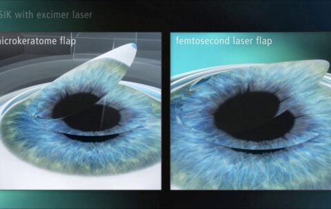Excimer Laser Refractive Surgery Course