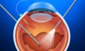 vitrectomy